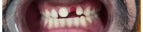 Conservative Tooth Preparation and Gum Contouring